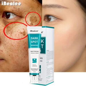 iBeaLee Whitening Freckle Cream Remove Melasma Cream Remove Dark Spots Melanin Melasma Remover Brighten Skin Anti-Aging 1