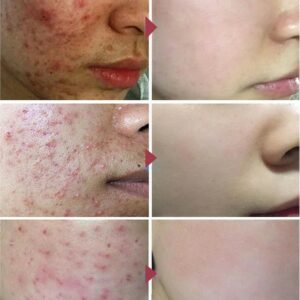 Effective Acne Removal Cream Herbal Acne Spots Oil Control Acne Cream Skin Care Whitening Moisturizing Face Gel Skin Care 20g 2